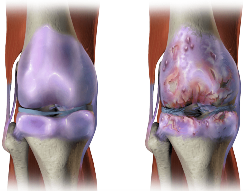 artrose ou desgaste nas juntas